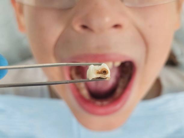 Best Dentist for Tooth Abscess  in Clton, IN